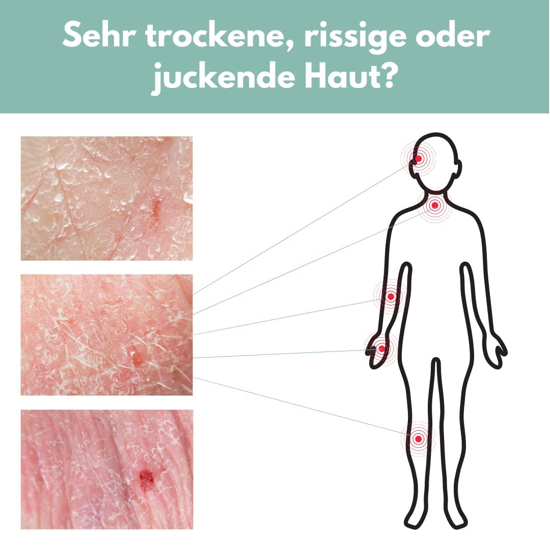 benevi ISO-Intensivcreme 75 ml mit Magnesium und Urea für trockene juckende schuppende Haut - auch als Basispflege bei Altershaut und zu Neurodermitis oder Schuppenflechte neigender Haut