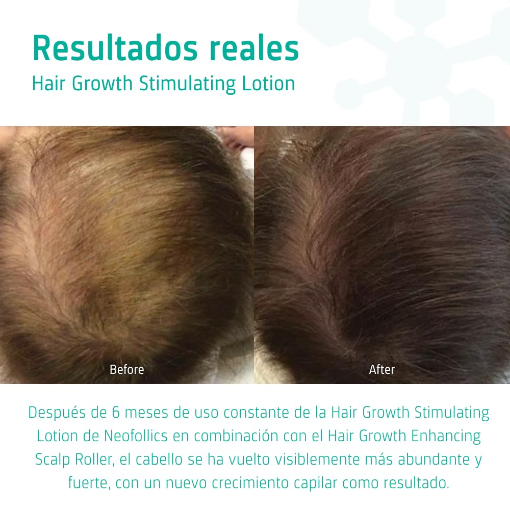 Loción Capilar Neofollics Estimulante para el Crecimiento del Pelo - Con Acción Anticaída y Fortalecedora - Contiene 7% de Neoxyl - 90 ml