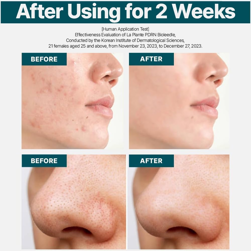 MD'S PICK LA Plante PDRN Hyaluronic Bioleedle Serum 1 Million Shots (Vegan Reedle, Hydrate & Reduce Wrinkles, Pore-Tightening, Hyaluronic Acid, PDRN Serum, Korean Skin Care)
