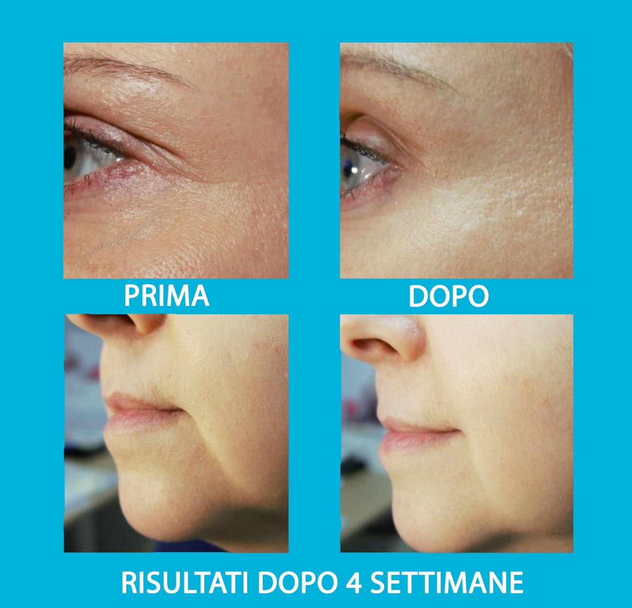 UB Gel con Acido Ialuronico per Ultrasuoni, Cavitazione e Trattamenti Microcorrente Viso – Gel Conduttore per Radiofrequenza, Massaggi Anticellulite ed Elettrostimolatore – Efficacia da Professionisti
