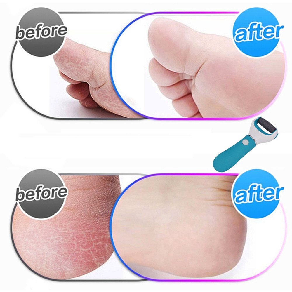 Râpe Electrique Express Soin des Pieds Usure des Pieds Réparation Broyage Exfoliation Anti-Callosités avec 2 Rouleaux de Remplacement Rechargeable USB (Style A)