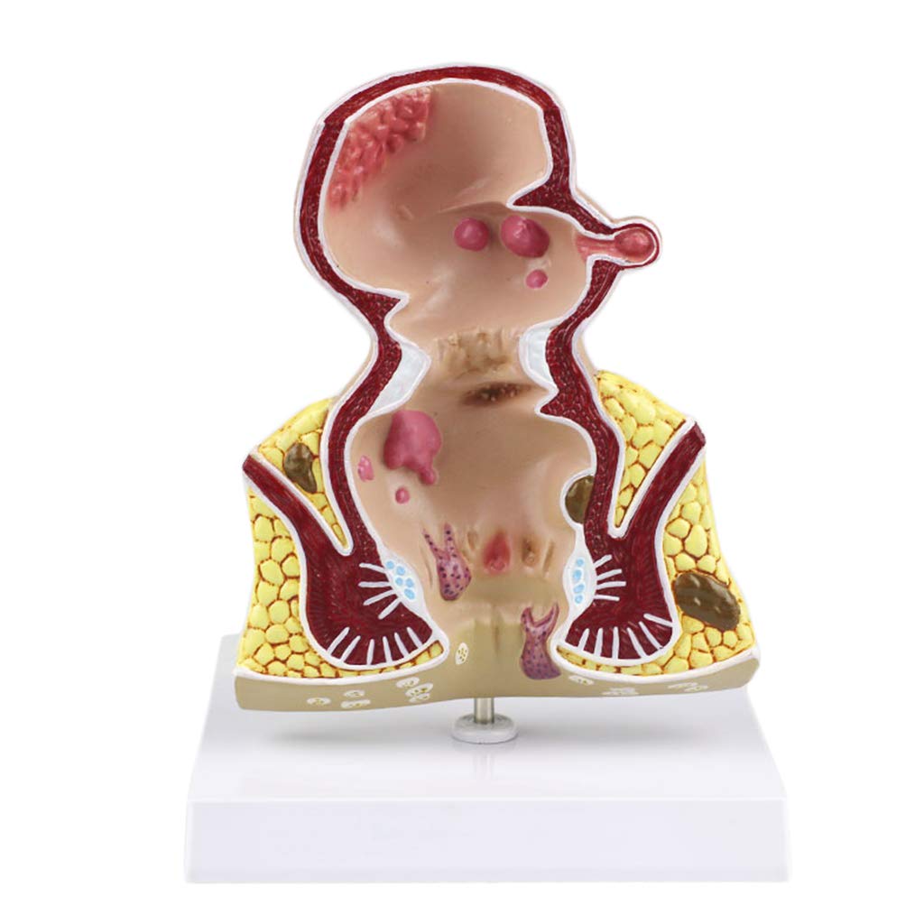 Sjdopulse Rectum Model - Disease Rectal Ulcer Acne Pathological Model -Human Digestive System Medical Anatomical Model - For Medical Educational Teaching Training Aid