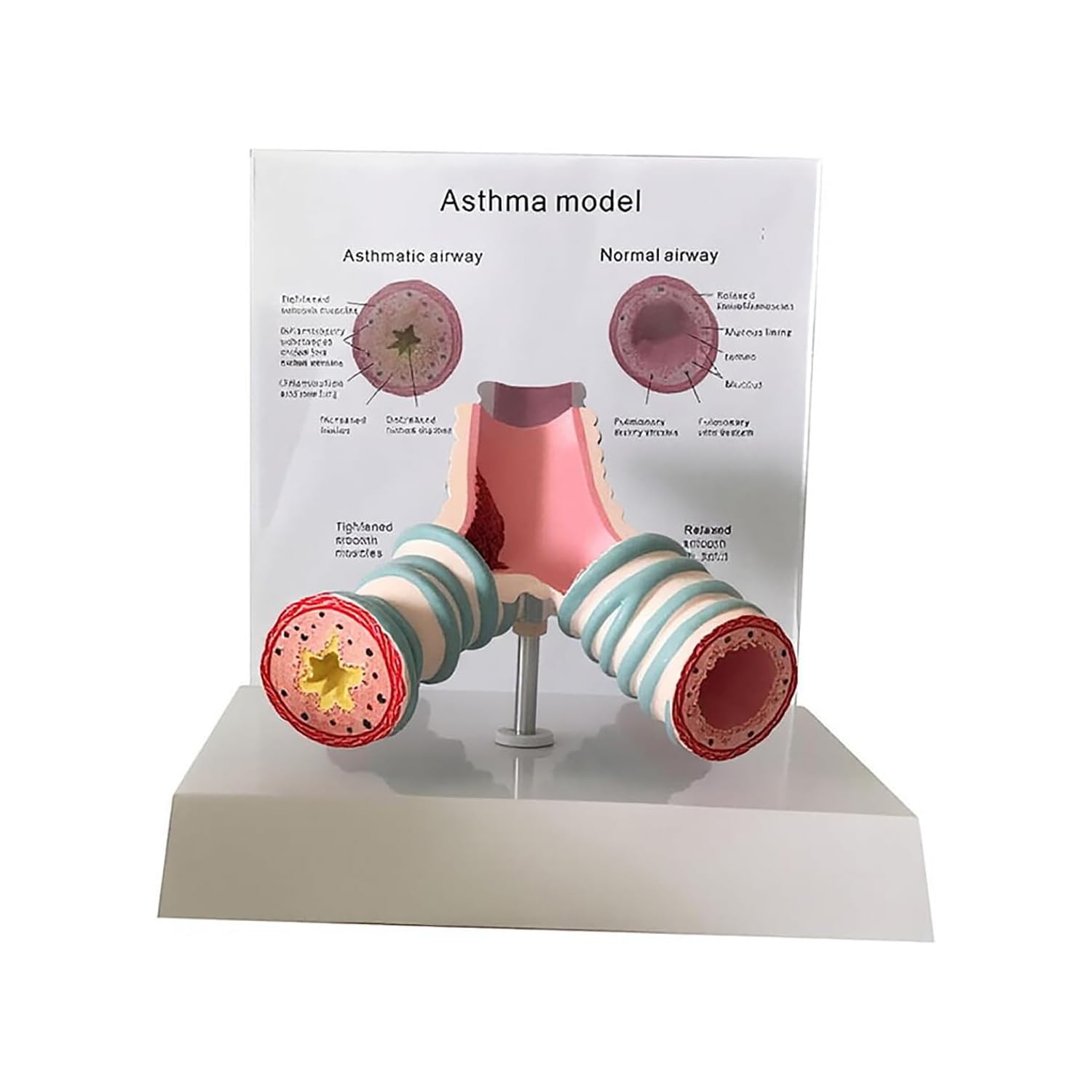 OSPSHPG Human Asthma Anatomy Model, Respiratory System Bronchial Model, with Back Card, for Students Study Display Teaching
