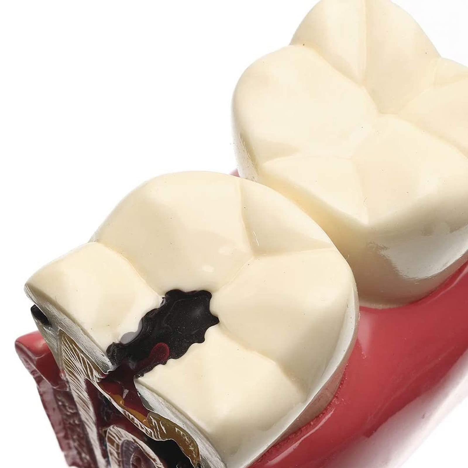 Modello di Dente con Carie Dentale, Modello di Denti Malati, Modello di Studio per pazienti odontoiatrici, Modello di Studio per confronto di Carie 6 Volte, Strumenti didattici