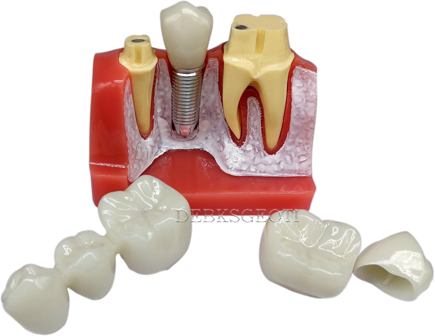 Dental Typodont Implant Model 4 Times Teeth Model Removable Analysis Crown Bridge Demo Teeth Model for Class Education and Studying M2017