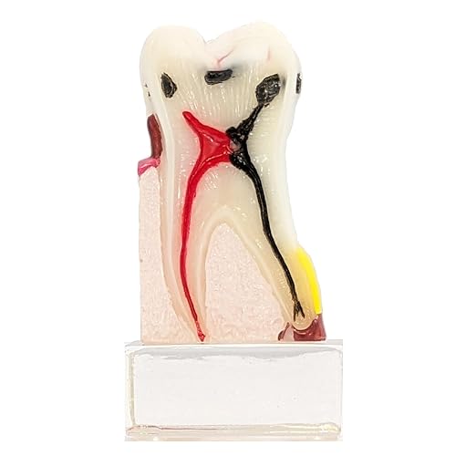 Axis Scientific Dental Model with Tooth Decay Scale - Enlarged 4 Times Life Size - Perfect for Dental Students, Dentists, Patient Consultation - Durable Clear Resin Base