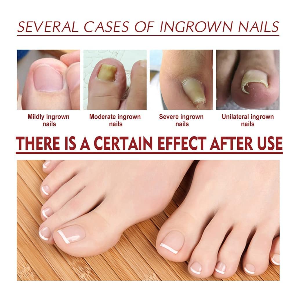 German Toenailplus Anti Paronychia Relief Oil,10ML Anti Paronychia Relief Oil, Ingrown Toenail Drops, Nail Helper Ingrowth Toenail Correction Treatment Oil Zehennagel Tropfen (4PC)