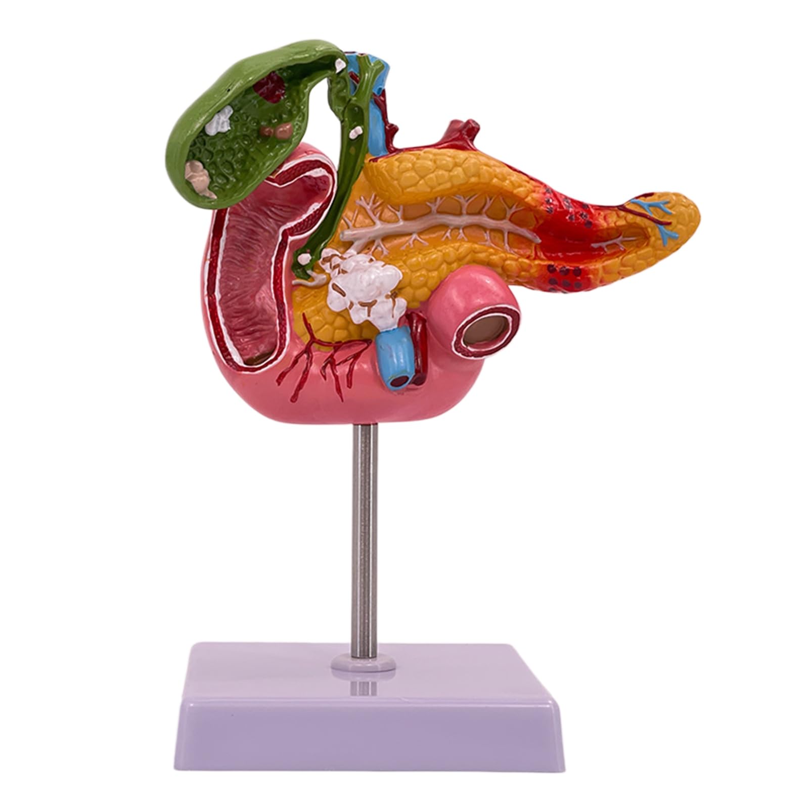 YRQMGSF Gallbladder Pathology Model - Pancreatic Duodenal Model - for Study Teaching Display Medical Model