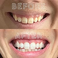 Vista 6 de MOON Kit de blanqueamiento de dientes, dispositivo LED blanqueador de dientes platino, 28 tiras blancas disolventes, bandeja blanqueadora de luz