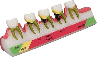 Dental Periodontal Disease Model Different Stages Dental Periodontitis Display Model for Dentist and Patients Communication and Education