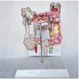 Educational Model Human Colorectal Disease Model - Human Organ Anatomical Model Colorectal Lesion Model - Medical Anatomical Human Colon Home
