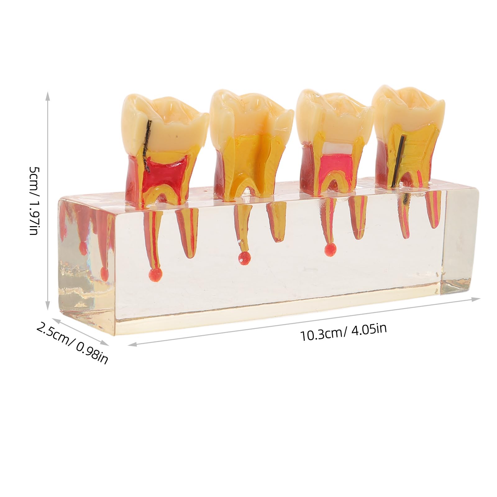 ibasenice Modello di denti pediatrici per la formazione didattica | Rappresentazione realistica dell'anatomia della bocca per studenti di odontoiatria e dentisti | Modello di carie per