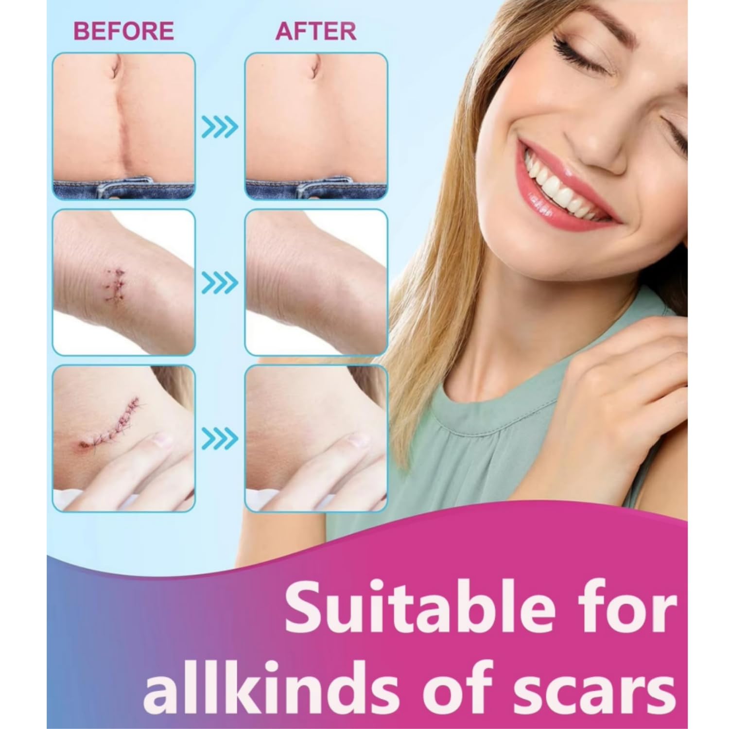 Bokor Silicone Scar Sheets, Silicone Scar Tape for Surgical Scars, Scar Removal Patches with Medical Grade Treatment (1.5M) - Image 2