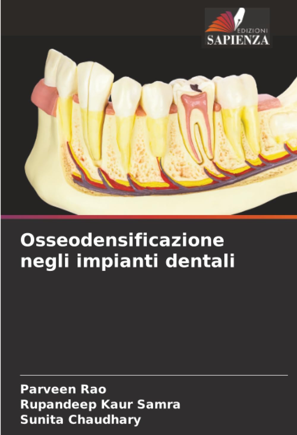 Osseodensificazione negli impianti dentali