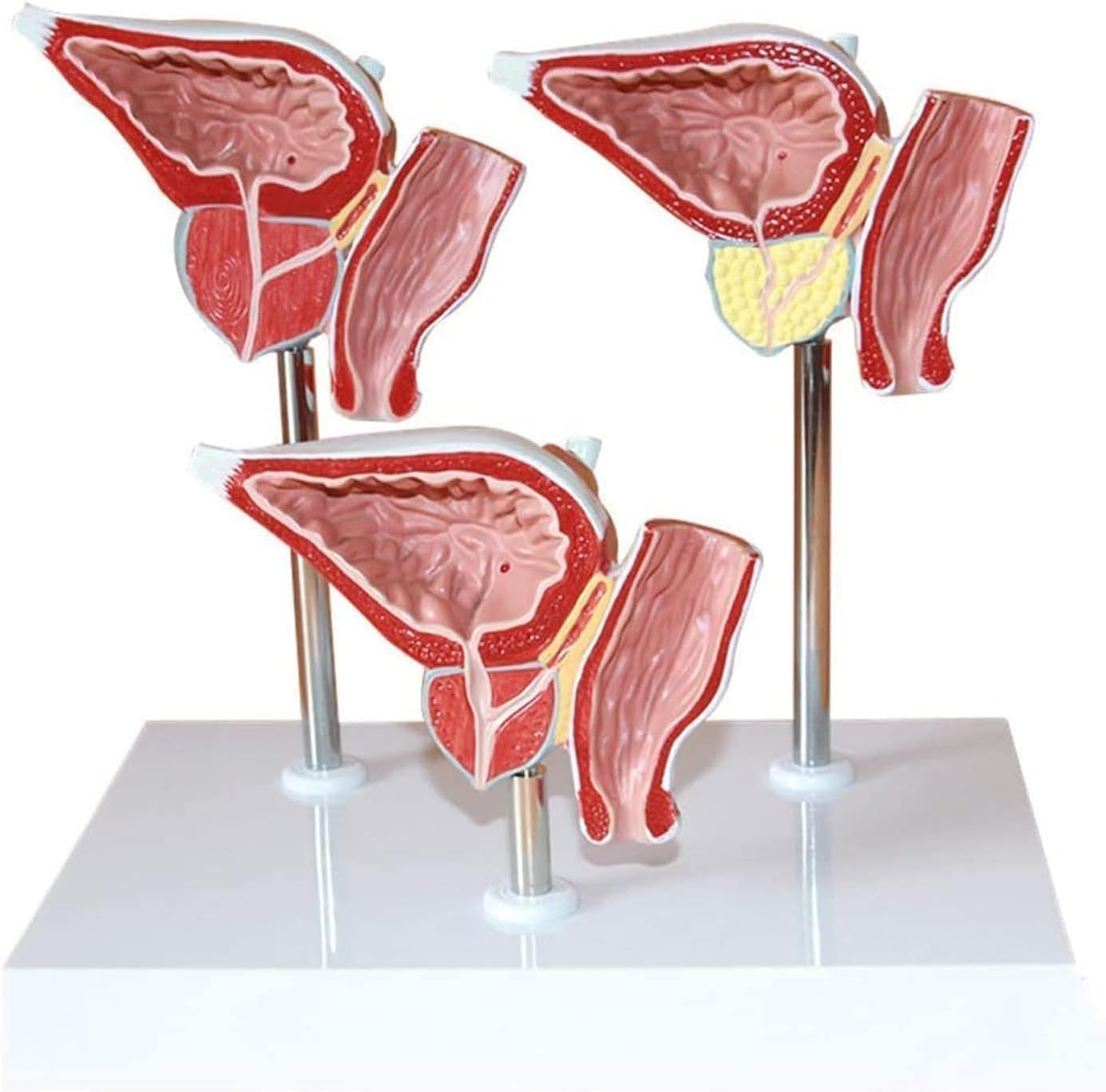 Human Prostate Pathological Anatomical Model, Male Urinary Reproductive System Educational Model, Including Anterior Gland, Rectum and Bladder, for Medical Research
