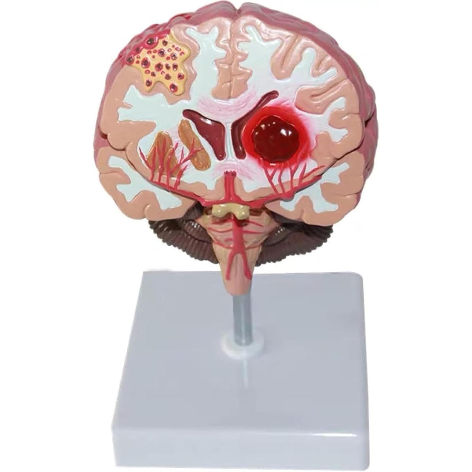 Modèle d'enseignement 1:1 du cerveau pour expliquer l'AVC en clinique
