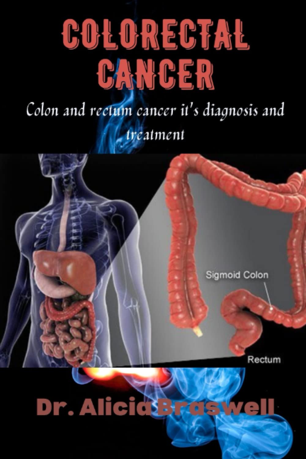 COLORECTAL CANCER: Colon and rectum cancer, it's diagnosis and treatment