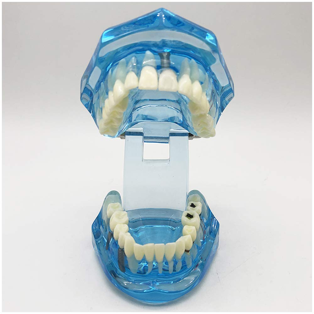 Modello di Denti da 2 Pezzi, Modello di Analisi di Studio di Impianti Dentali per Riparazione di Carie Dentale, Modello Dimostrativo per L'Insegnamento Medico, Forniture di Laboratorio