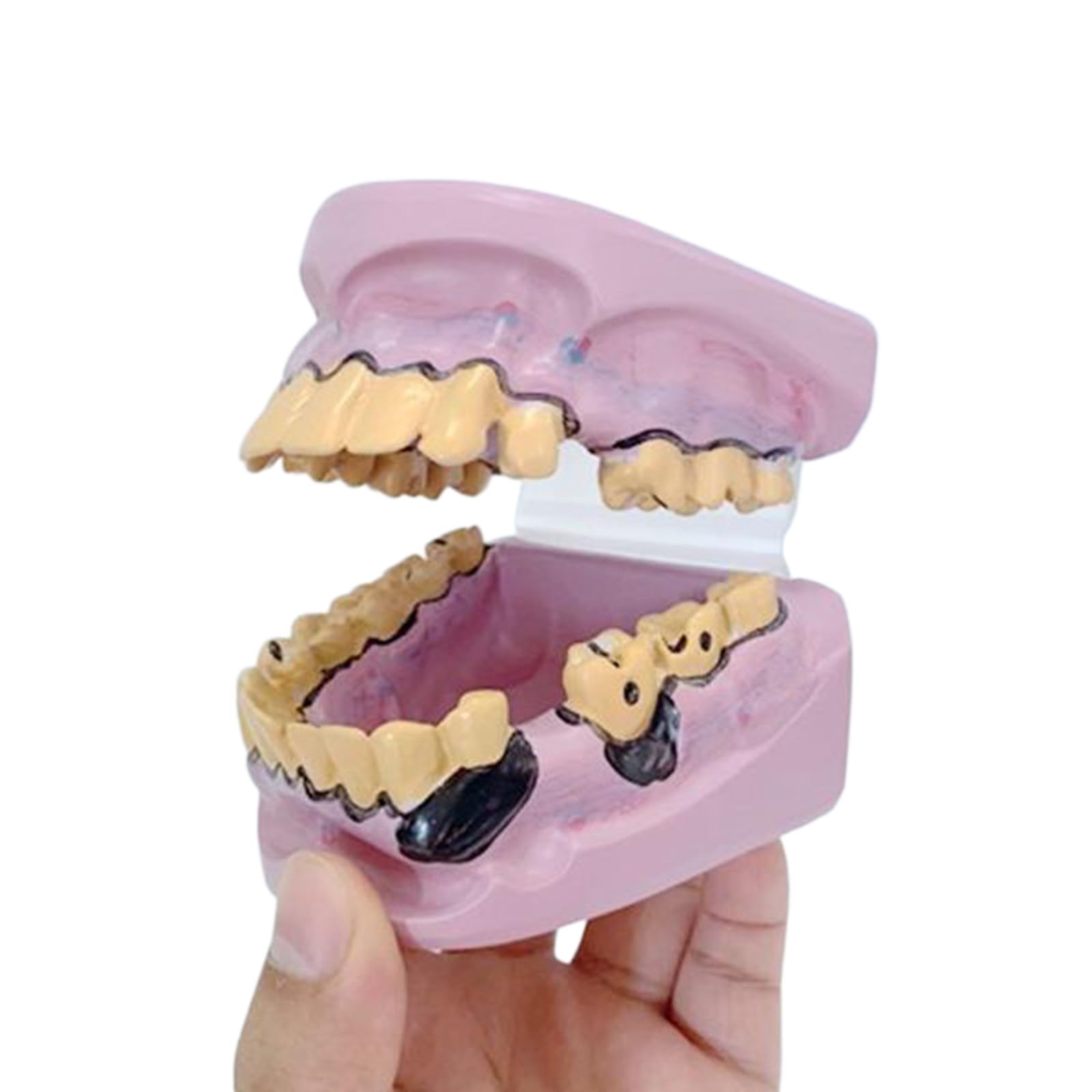 Modèle de pathologie Dentaire avec cavités et Caries dentaires Modèle d'anatomie Dentaire pour l'éducation Modèle de dent pour Exposition Dentaire