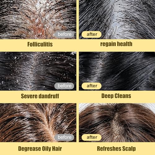 Newrey Anti-Dandruff And Anti-Fungal Shampoo thumb #3