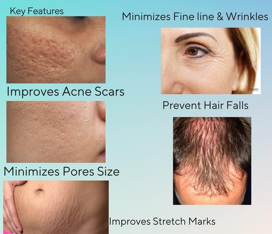 Image of Derma Roller 0.5mm With 540 Titanium Needles | Suitable for Anti-aging | Open Pores | Acne Scars | Hair & Beard Growth | Skin Care | Women and Men