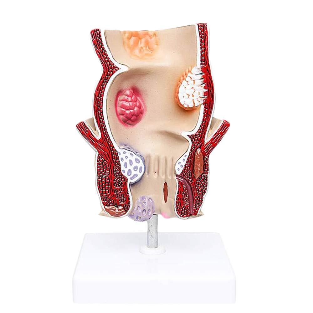 Sjdopulse Rectal Pathological Model - Anorectal Acne Pathology Model - Medical Teaching Hemorrhoids Pathology Model - Rectal Intestinal Anatomical Model - For Teaching Study Display