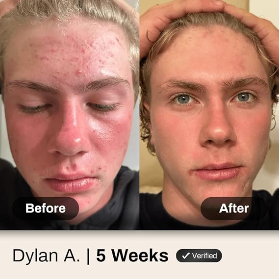 Acne System for Men and Boys, Face Wash, Moisturizer, Pimple Patches, Shield Men's Skin Care Set (2 Months)
