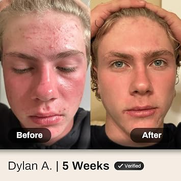 Acne System for Men and Boys, Face Wash, Moisturizer, Pimple Patches, Shield Men's Skin Care Set (2 Months)