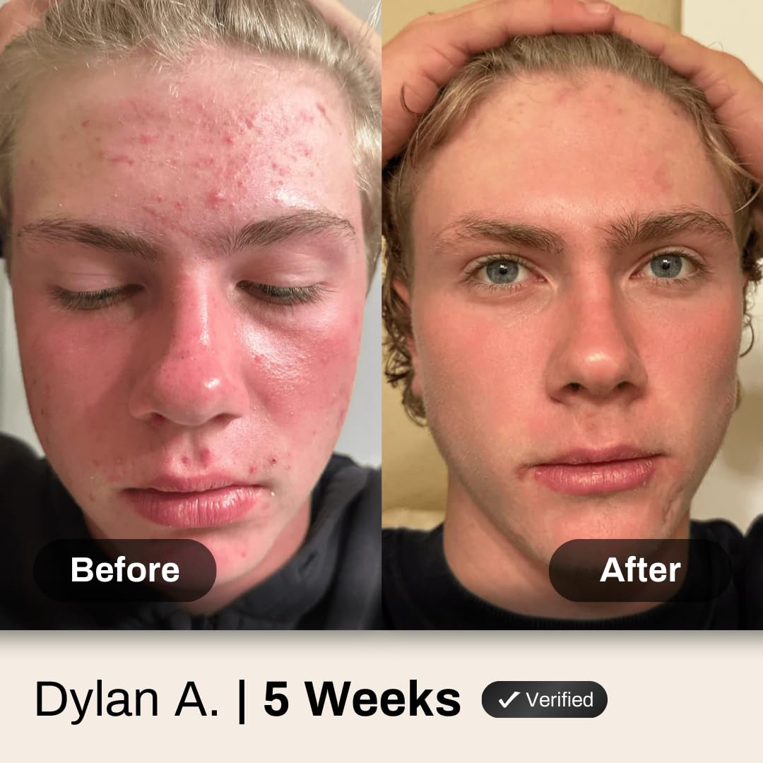 Acne System for Men and Boys, Face Wash, Moisturizer, Pimple Patches, Shield Men's Skin Care Set (2 Months)