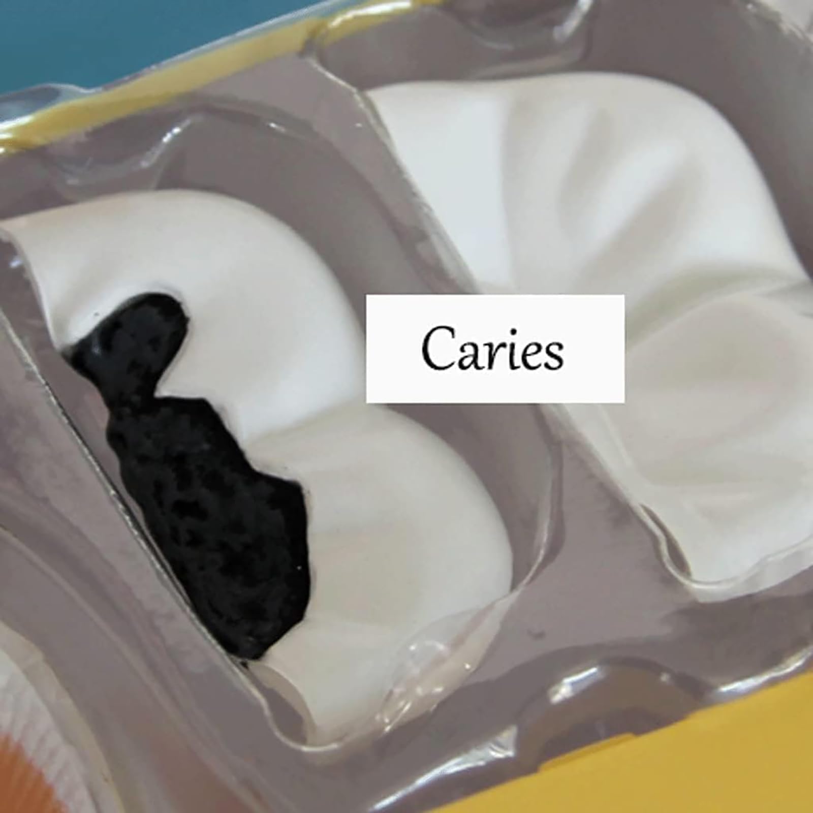 NGARY Model struktury ludzkich zębów 4D, model anatomii zębów, model zdejmowanych zębów, model demonstracyjny dentystyczny z 23 akcesoriami, do pomocy edukacyjnej