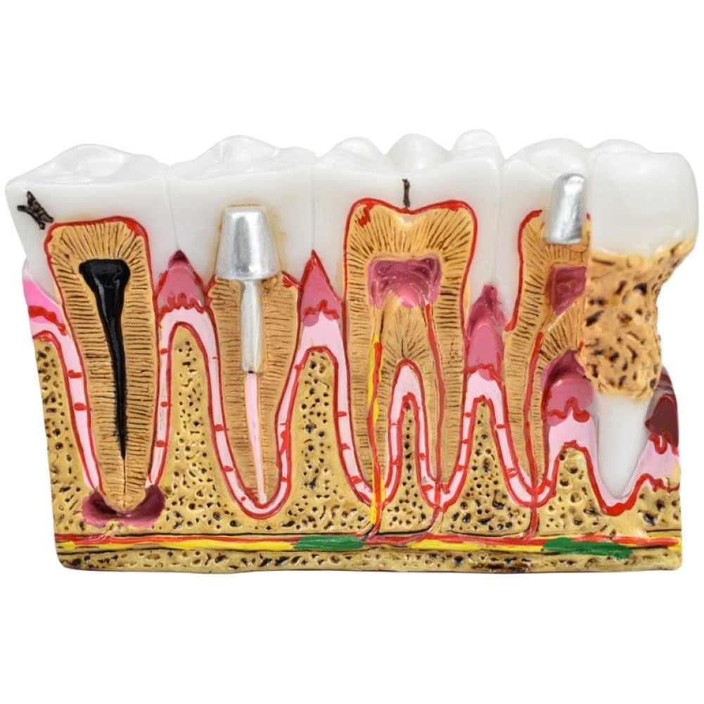 Modèles d'étude de comparaison des caries de développement