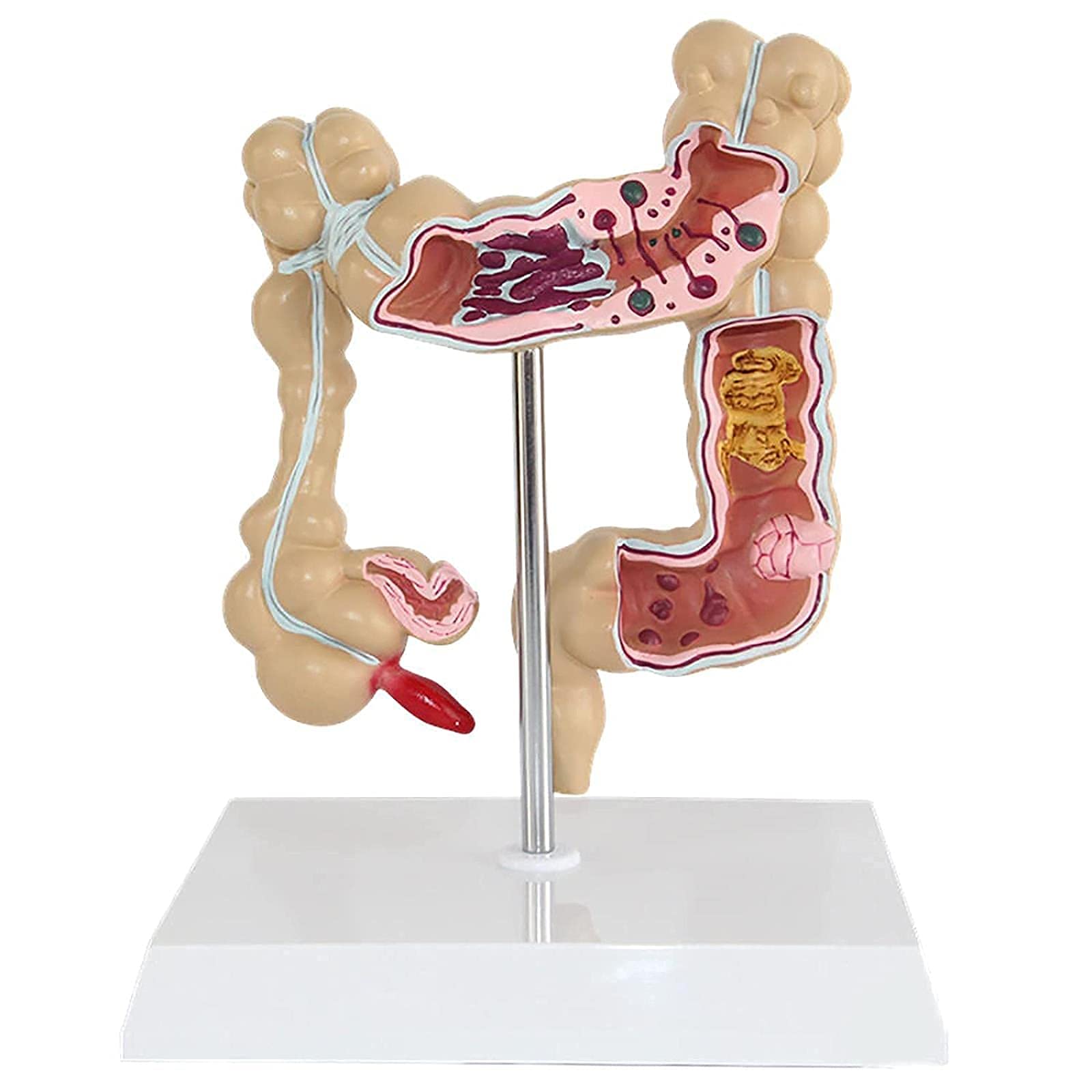 Medical Model Human Colon Disease Model Large Intestine Pathology Model Rectal Appendix Model Anorectal Doctor Patient Communication Model T