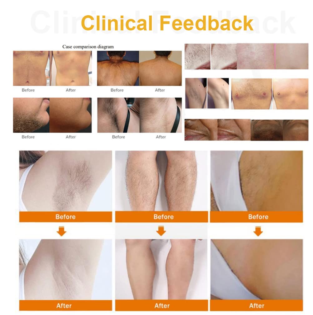 Dispositivi per la depilazione con ghiaccio 755nm 1064nm 808 per gambe/corpo/area sensibile, epilatore permanente indolore Attrezzature per saloni 20 milioni di colpi