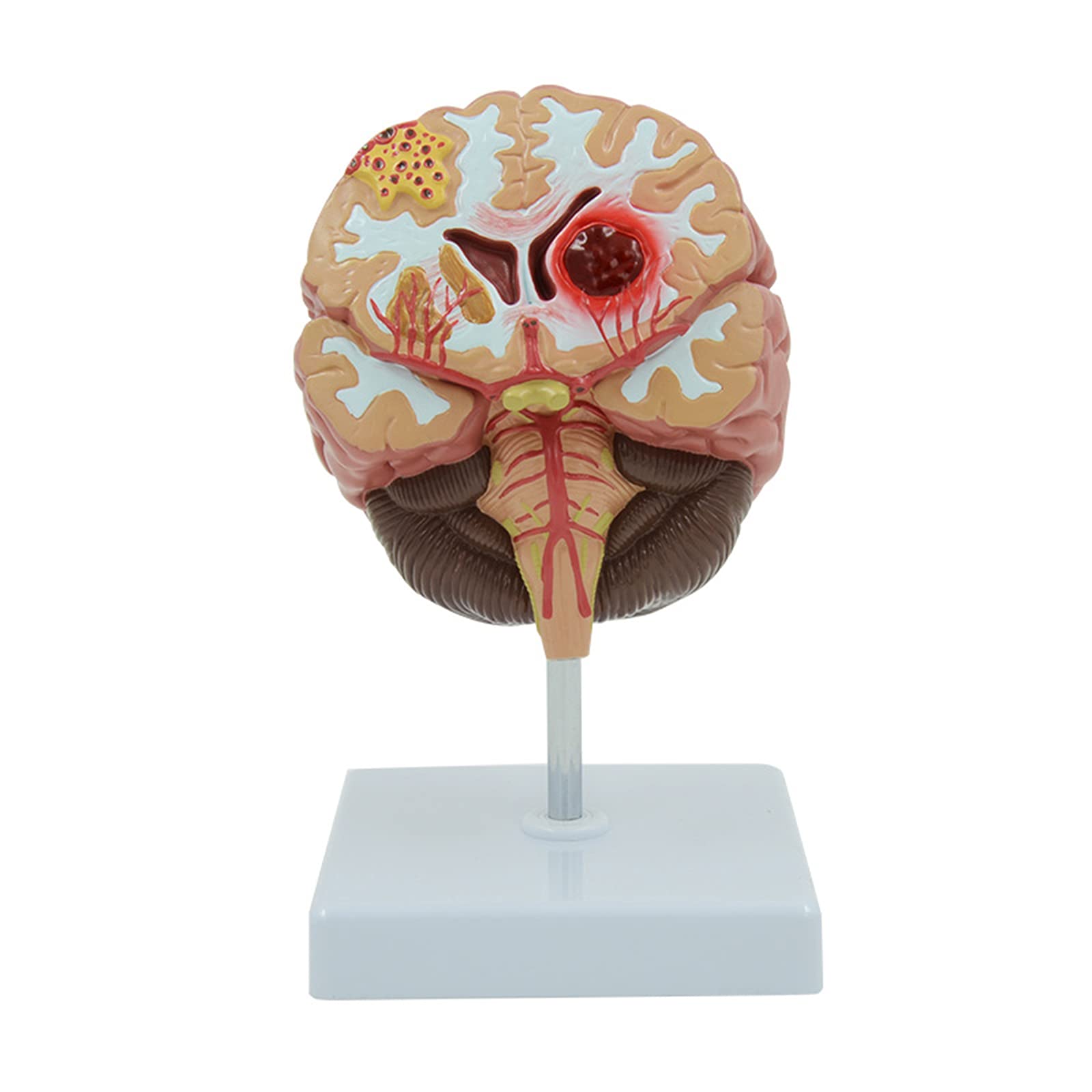 KJMWXOP Human Brain Anatomical Model, Cerebral Hemorrhage Arteriovenous Malformation Pathological Model, Science Learning Demonstration Teaching Model