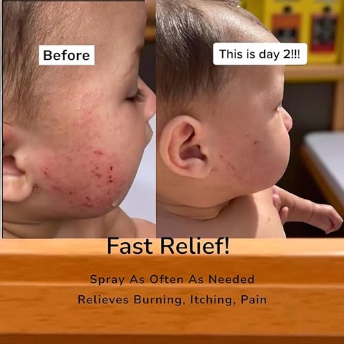 Miniatura 5 de Loma Lux Nuevo Eczemol OTC Spray natural y sin picazón hipocloroso para eccema, heridas, quemaduras, cortes, dermatitis por radiación, irritación de