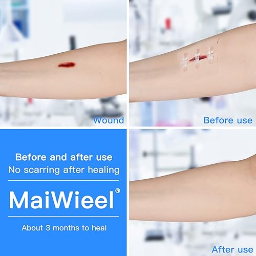 Miniatura 10 de Reparación de laceración de puntada con cremallera sin puntadas, vendas de mariposa, coágulo rápido, dispositivo de cierre de heridas de emergencia,
