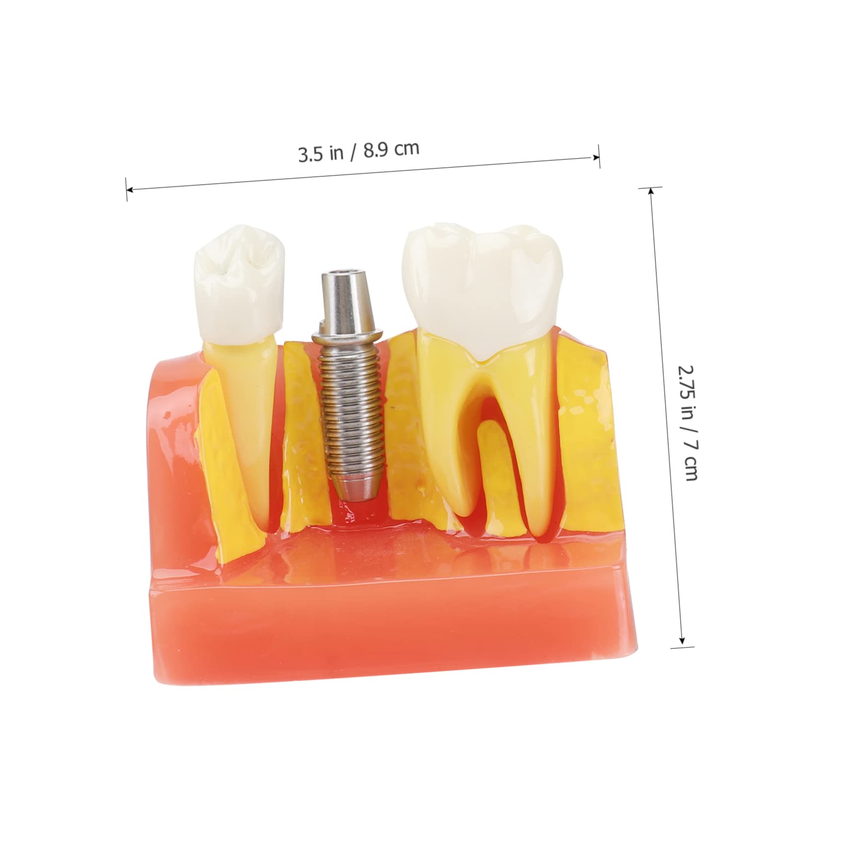 1pezzi Modello di Denti con Denti Rimovibili Strumento Didattico per Insegnamento e Studio Odontoiatrico Modello di Impianto e Protesi Fissa Incluso