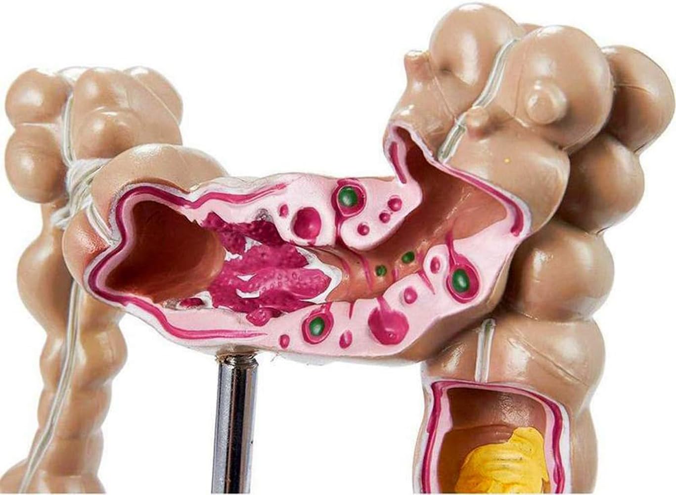 Model patologicznej zmiany jelita grubego człowieka, naturalnie duże narzędzie do nauczania anatomii do edukacji medycznej i treningu klinicznego