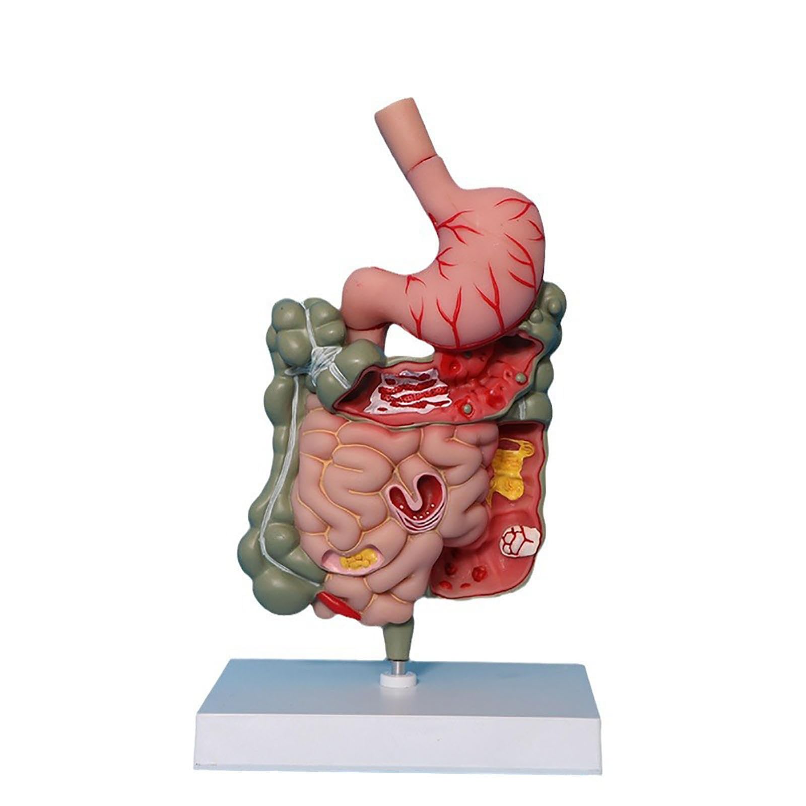 SORECI Human Stomach Anatomy Model Pathological Digestive System Model, Removerable Teaching Model,Stomach Section Large Small Intestine Medical Model Anatomy