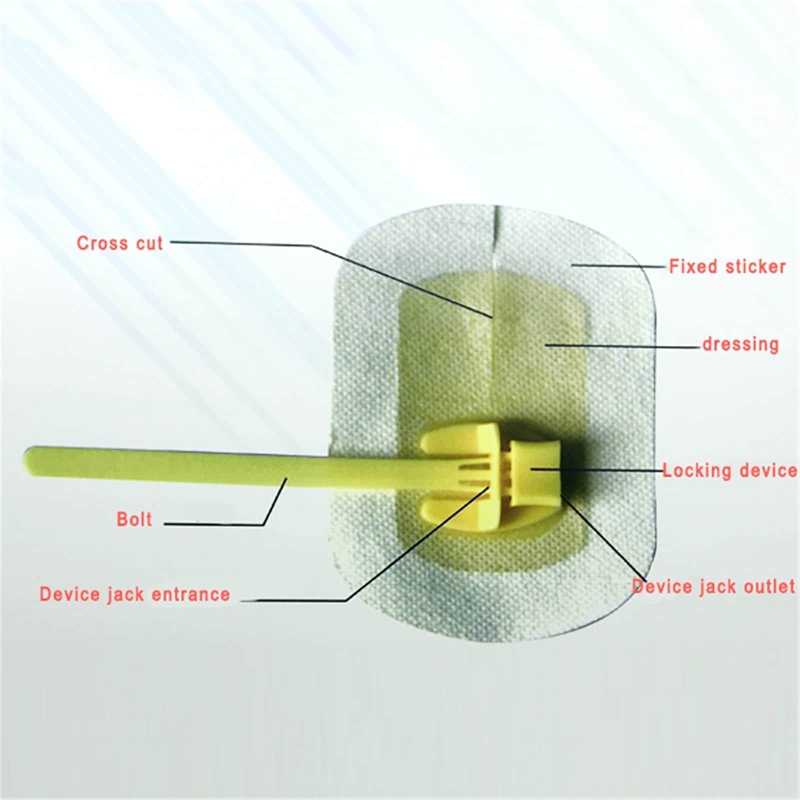 Bile Drainage Tube Fixing Device Catheter Stabilization Device Fistula ...