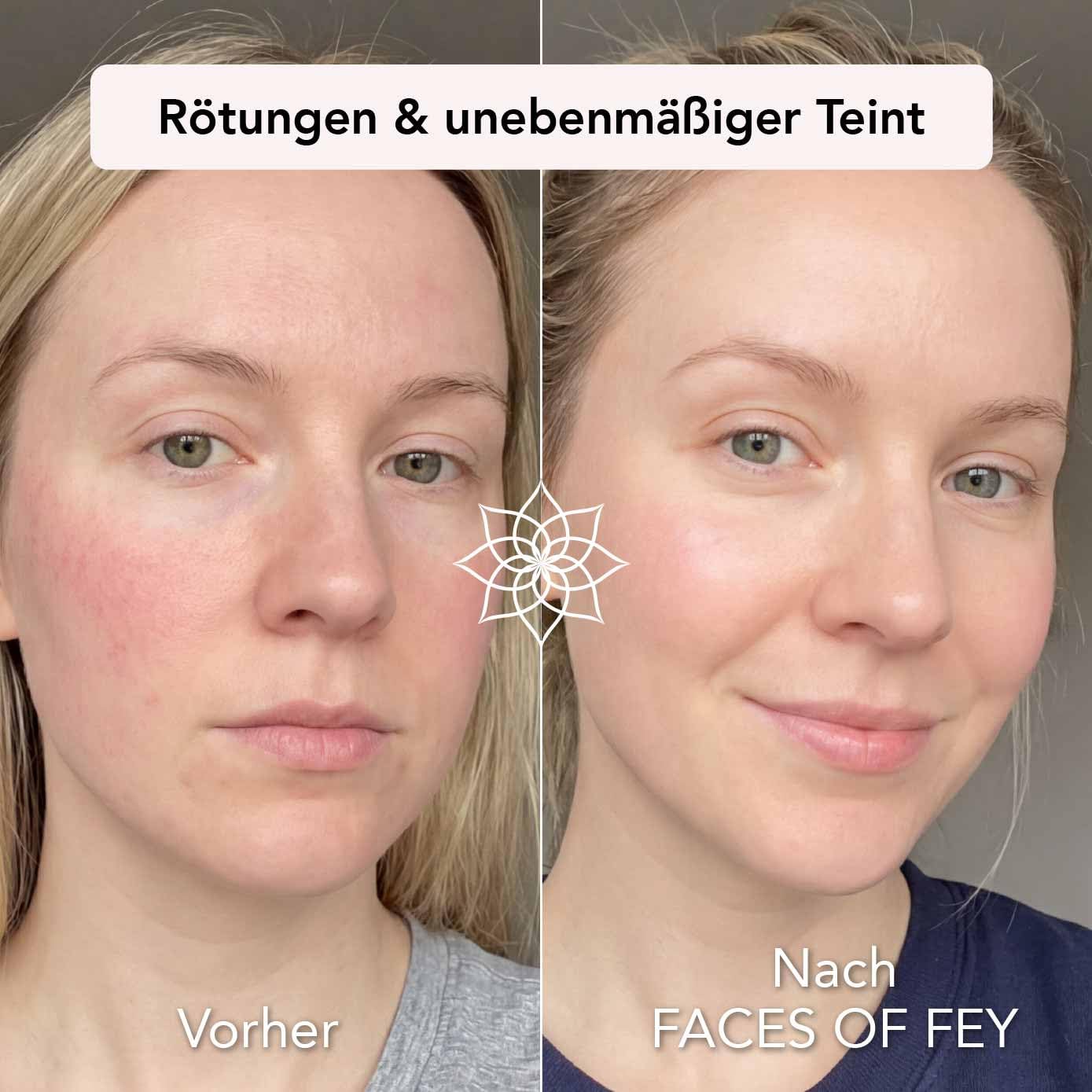 FACES OF FEY Derma roller 0,25 mm, 192 prawdziwe igły, 10% niacynamidu