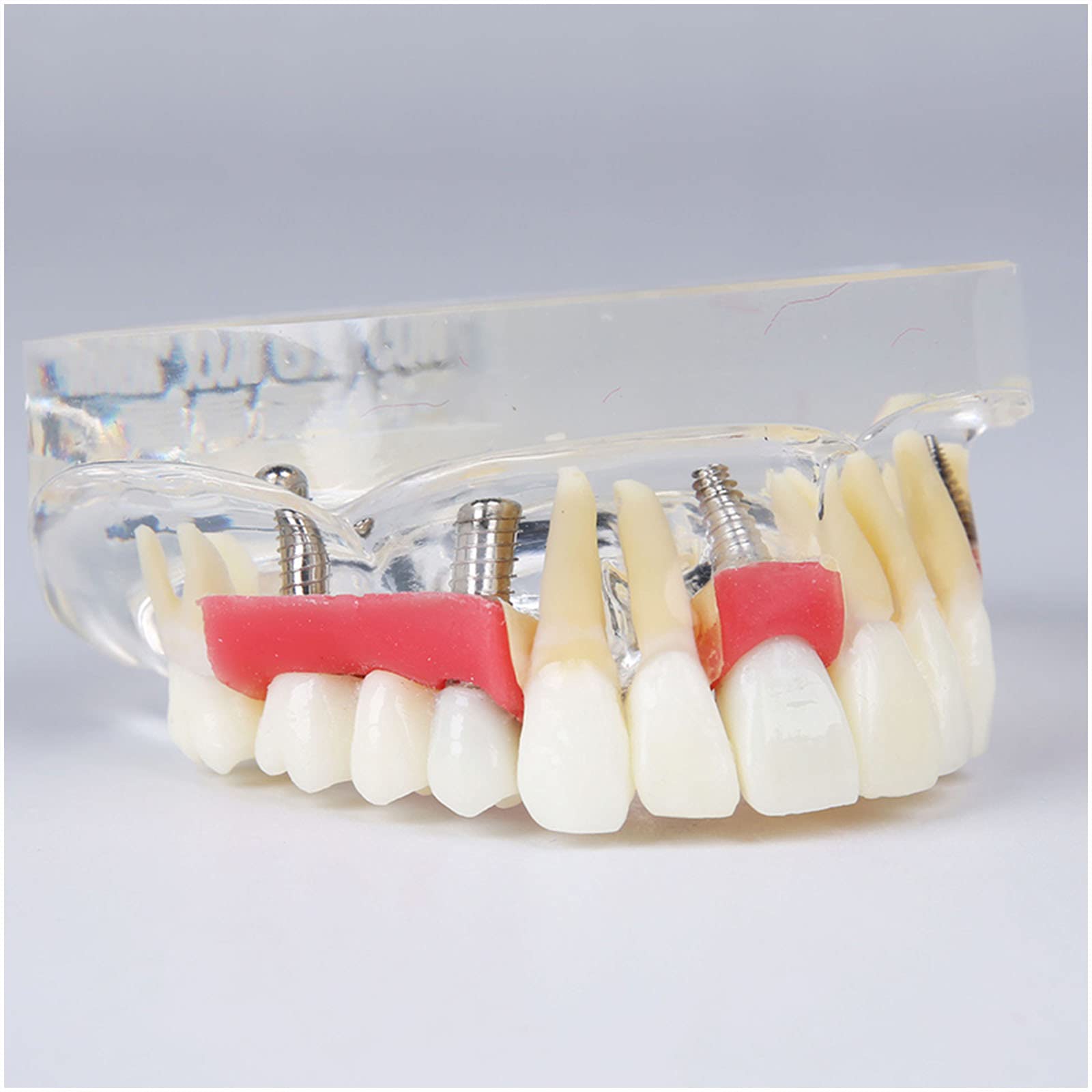 Modèle D'implant De Dents - Modèle De Restauration Supérieure De La Surventure De L'implant Dentaire - Modèle D'étude des Dents Dentaire avec Pilier, Ongle D'implant, Gomme Douce