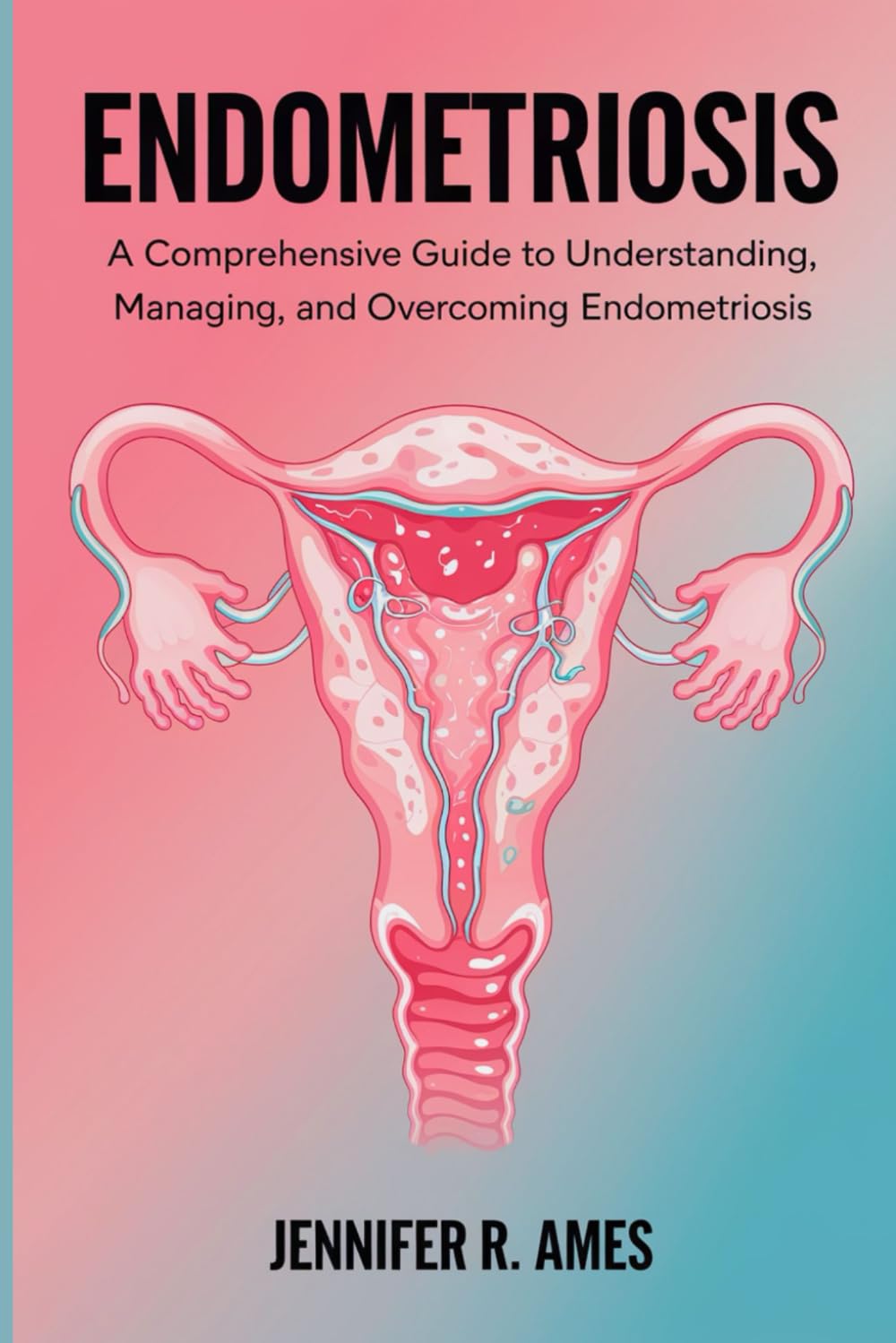 Endometriosis: A Comprehensive Guide to Understanding, Managing, and Overcoming Endometriosis