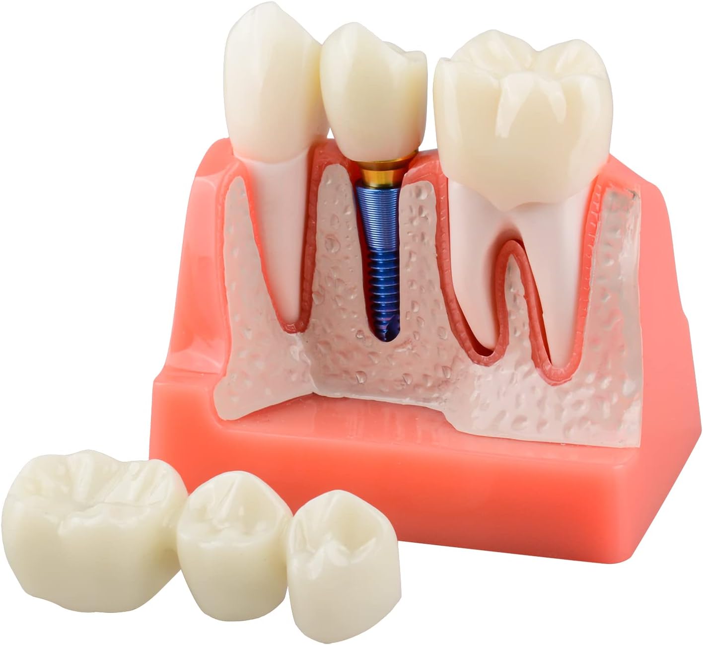 Ultrassist Dental Implant Model for Patient Education, 4 Times Dental Implant, Crown and Bridge Model for Presentation-Pink