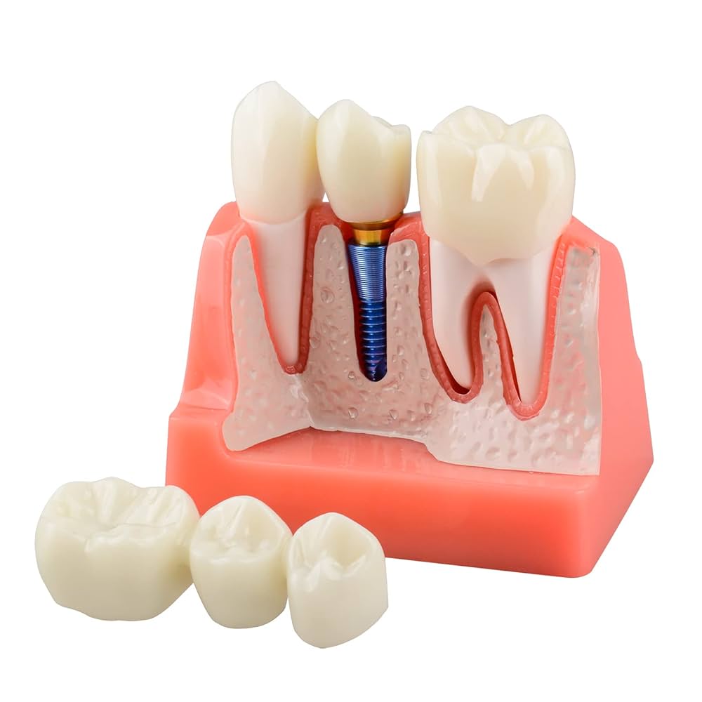 Amazon.com: Ultrassist Dental Implant Model for Patient