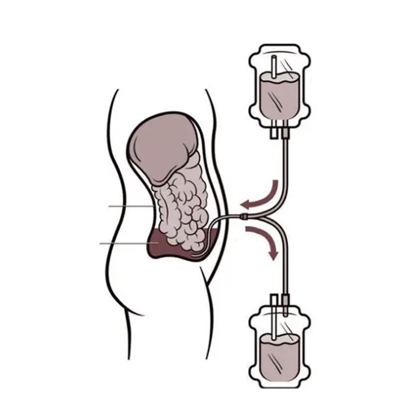 Modèle de dialyse péritonéale, mannequin de l'abdomen humain pour l'éducation médicale, démonstration et simulation avec design d'insertion de tube