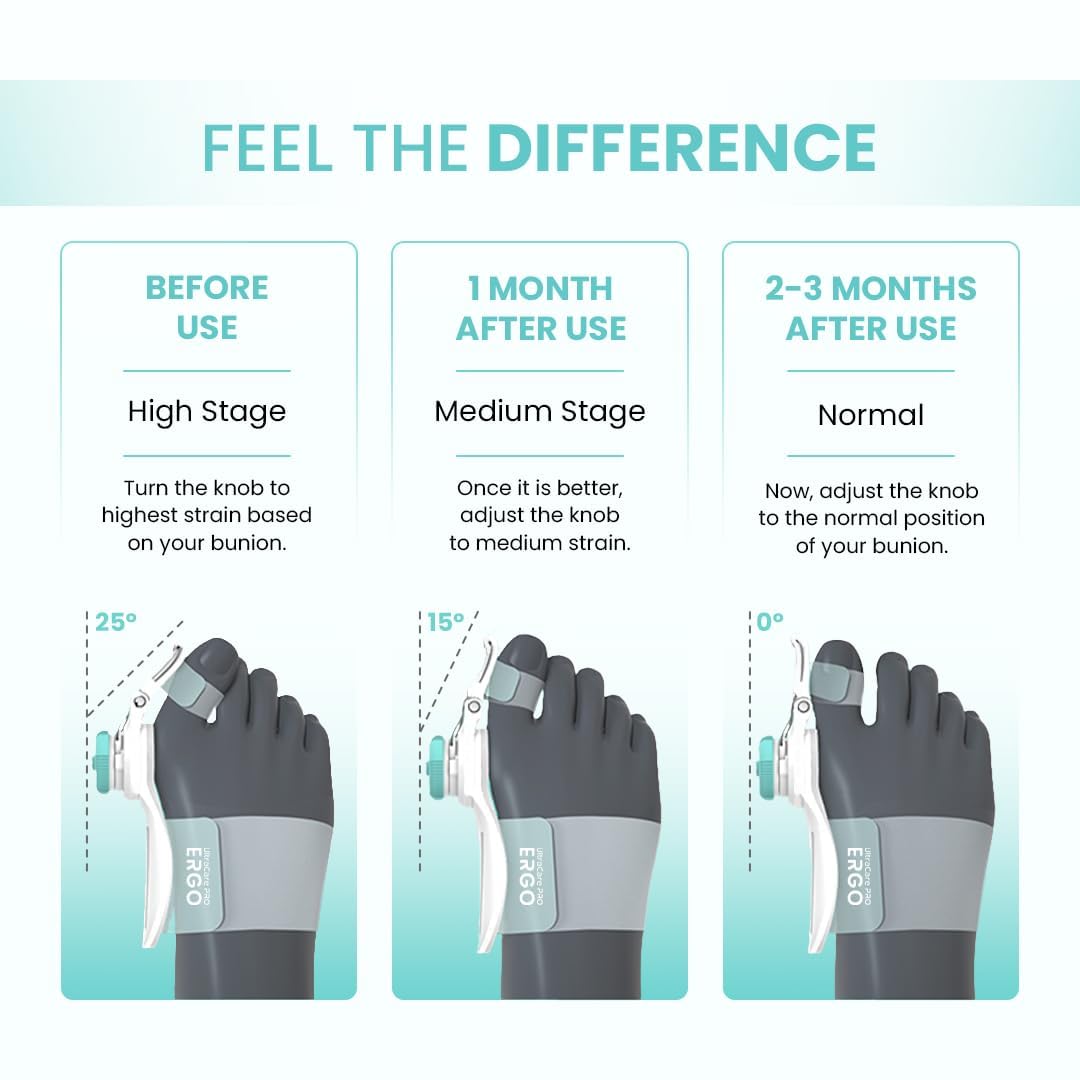 UltraCare PRO ERGO Bunion Corrector - 1 year Warranty - Orthopedic Bunion Toe Straightener - Foot Thumb Straightener - Foot Support - For Men & Women - Medical Grade Splint - 3D Adjustable Knob 2