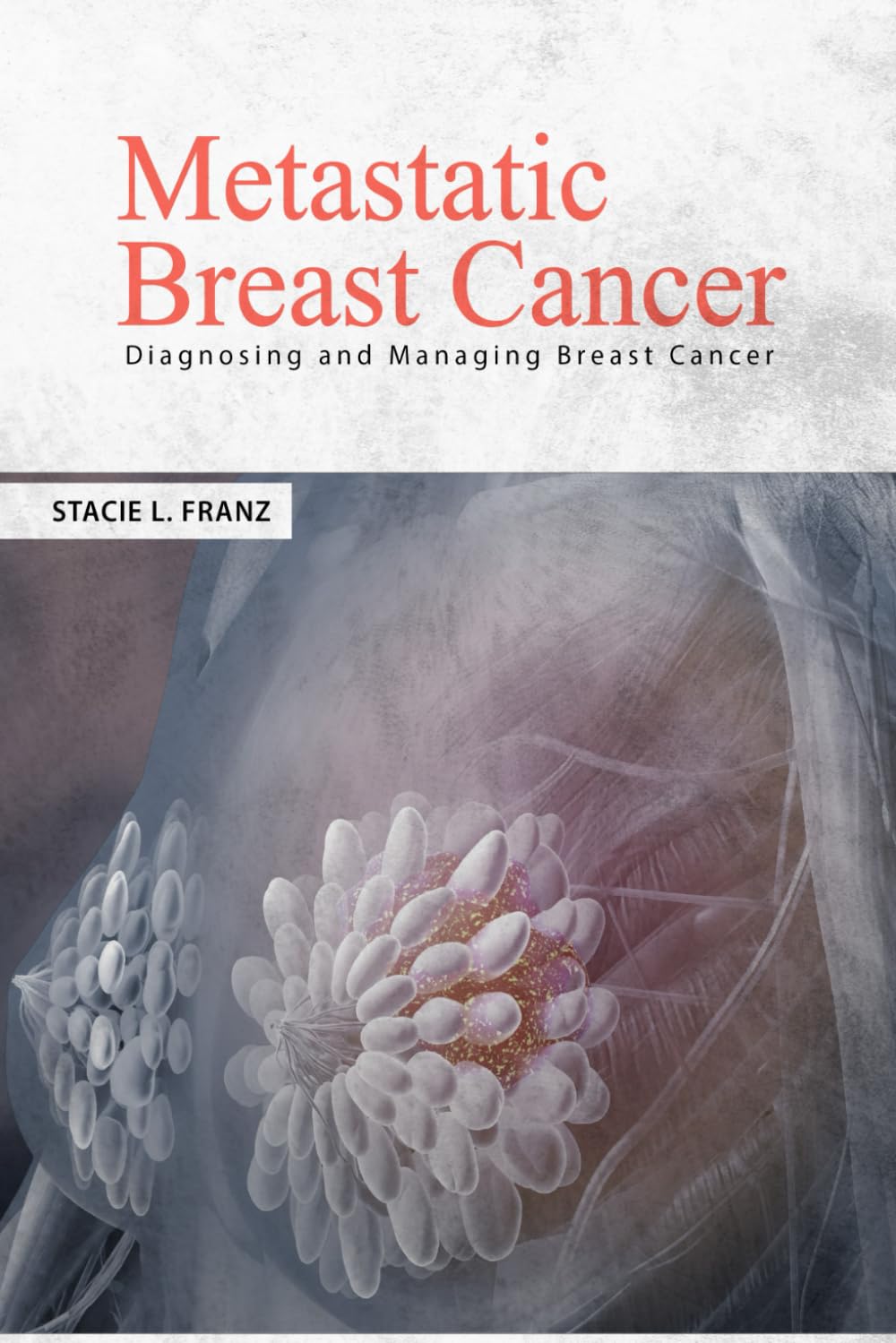 METASTATIC BREAST CANCER: DIAGNOSING AND MANAGING BREAST CANCER