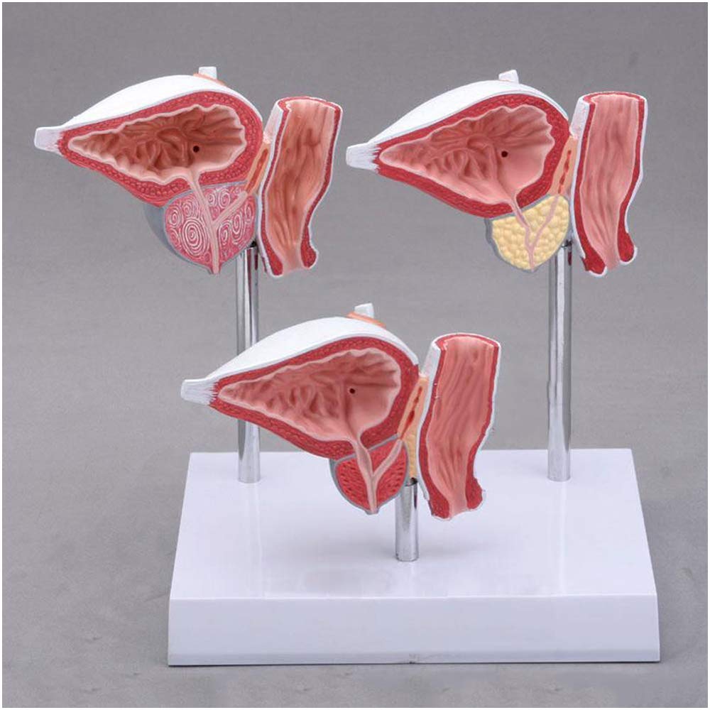 sjdoPulse Prostate Lesion Model - Genitourinary Medical Teaching Anatomical Model - Normal And Diseased Prostate Model - for Study Display Teaching Medical Model