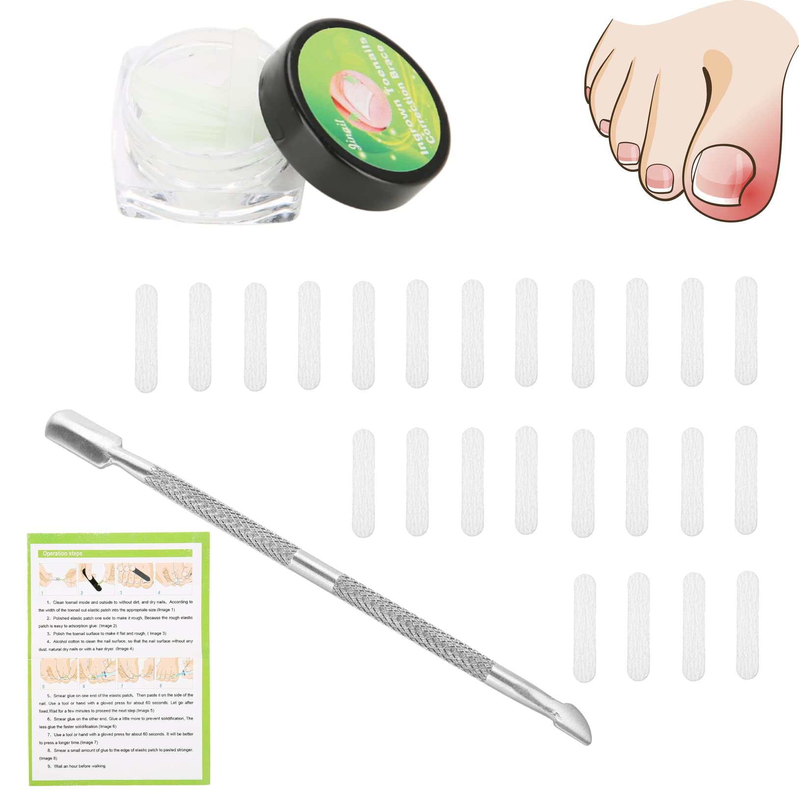 Pincer Nail Vs Ingrown Nail ubicaciondepersonas.cdmx.gob.mx